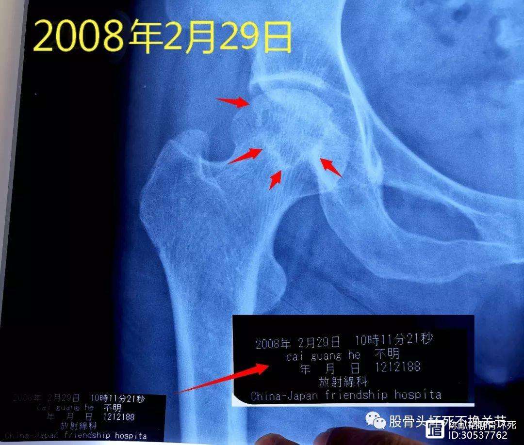 巢湖人工骨头医保报销多少(人工骨头医保报销多少比例)
